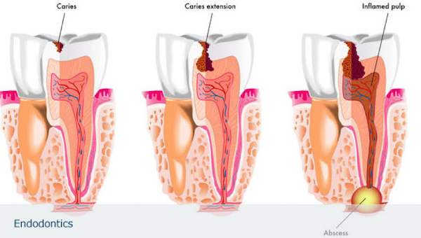 desvitalizar dente mafra